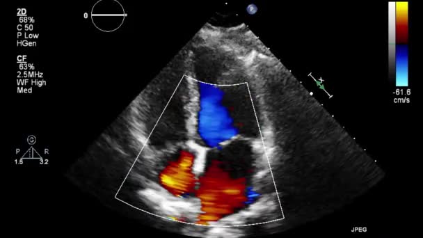 Badanie Ultrasonograficzne Przełyku Serca — Wideo stockowe