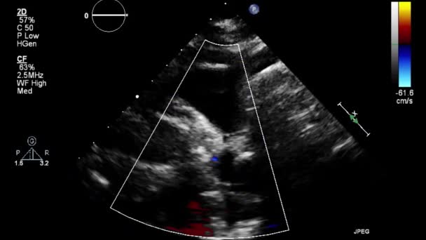 Transesofageale Echografie Onderzoek Van Het Hart — Stockvideo