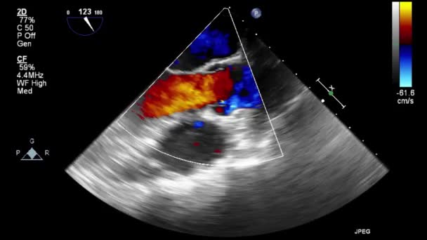 Трансофагеальное Ультразвуковое Исследование Сердца — стоковое видео