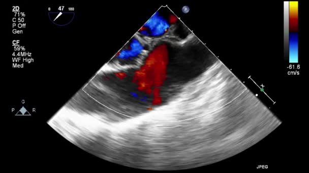 Transesofageale Echografie Onderzoek Van Het Hart — Stockvideo