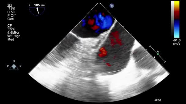 Transesofageale Echografie Onderzoek Van Het Hart — Stockvideo