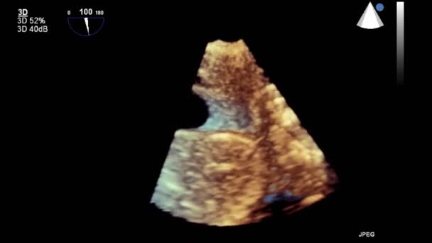 Transesofageale Echografie Onderzoek Van Het Hart — Stockvideo