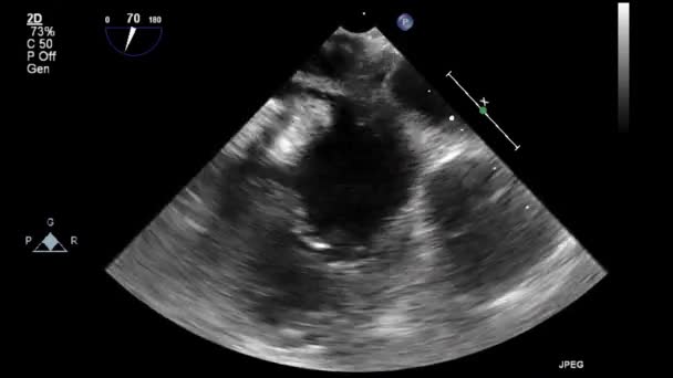 Transesophageal Ultrasound Examination Heart — Stock Video