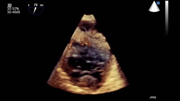 Transesofageale Echografie Onderzoek Van Het Hart — Stockvideo