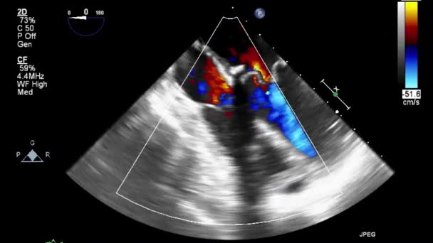 Ecografía Transesofágica Del Corazón — Vídeos de Stock
