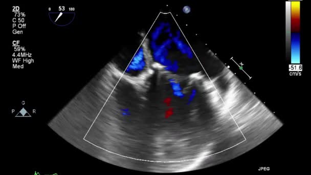 Трансофагеальное Ультразвуковое Исследование Сердца — стоковое видео