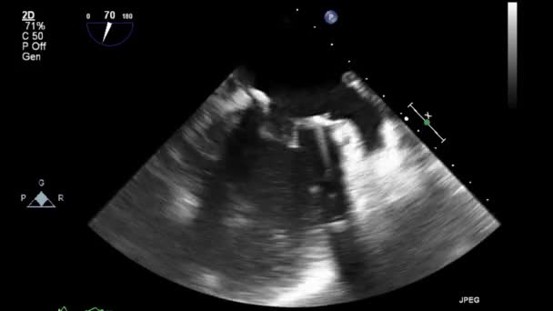 Examinarea Ultrasunete Transsesofagiană Inimii — Videoclip de stoc