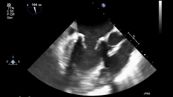 Kalbin Transsofageal Ultrason Muayenesi — Stok video