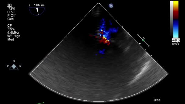 心臓の経食道超音波検査 — ストック動画