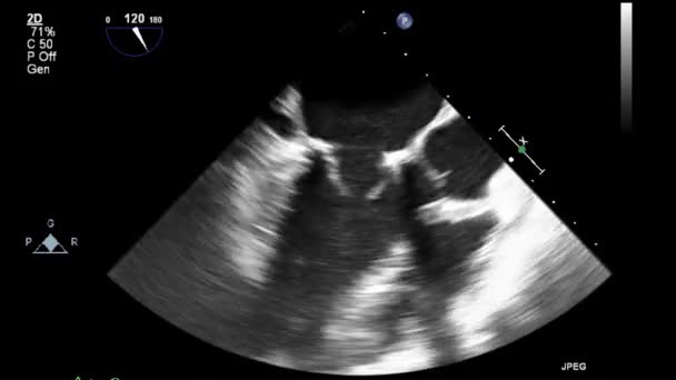 Transesofageale Echografie Onderzoek Van Het Hart — Stockvideo