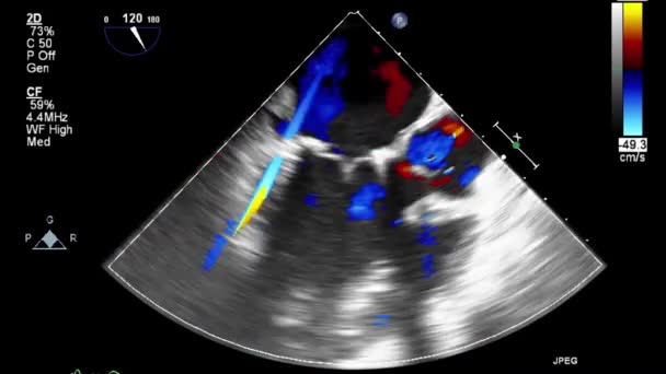 Трансофагеальное Ультразвуковое Исследование Сердца — стоковое видео