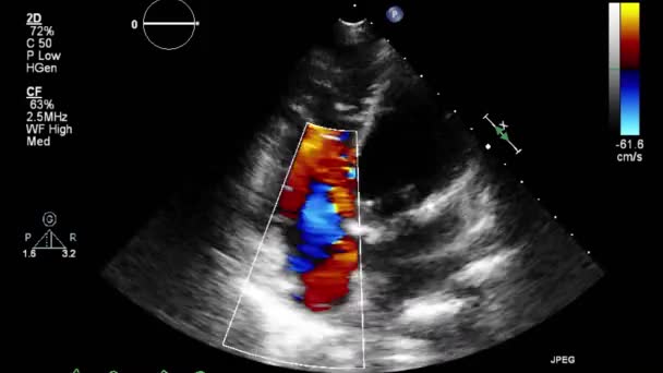 Transesophageale Ultraschalluntersuchung Des Herzens — Stockvideo