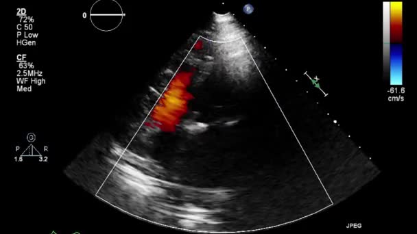 Transesophageale Ultraschalluntersuchung Des Herzens — Stockvideo