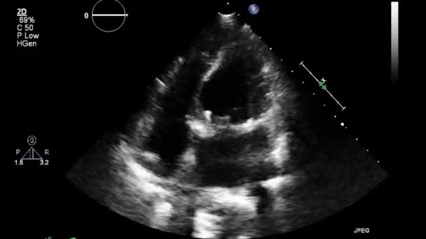 Transesofageal Ultraljudsundersökning Hjärtat — Stockvideo