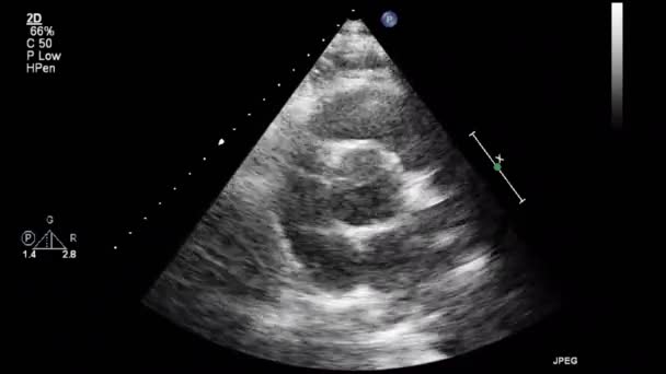 Transesophageale Ultraschalluntersuchung Des Herzens — Stockvideo