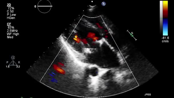 Transesofageální Ultrazvukové Vyšetření Srdce — Stock video