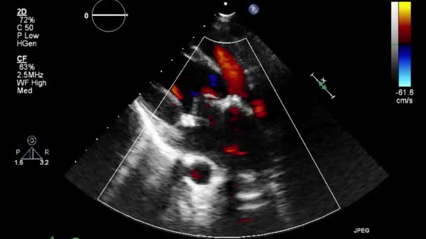 Exame Ultrassonográfico Transesofágico Coração — Vídeo de Stock