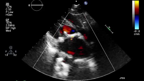 Transesophageal Ultrasound Examination Heart — Stock Video