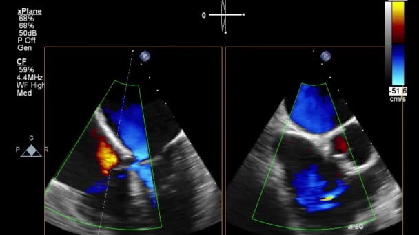 Transesophageal Ultrasound Examination Heart — Stock Video