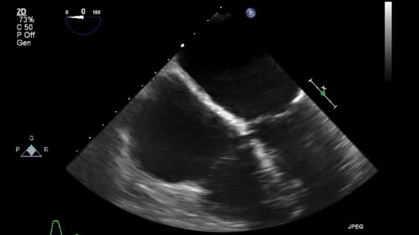 Transesofageal Ultraljudsundersökning Hjärtat — Stockvideo