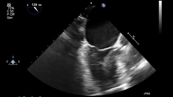 Ecografía Transesofágica Del Corazón — Vídeos de Stock