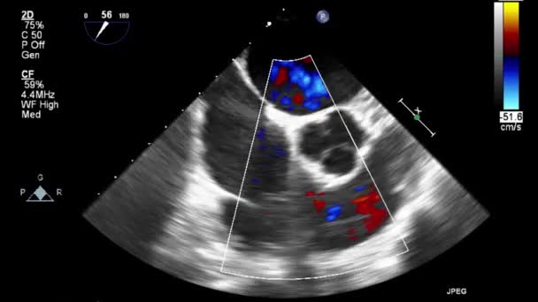 Ecografia Transesofagea Esame Del Cuore — Video Stock