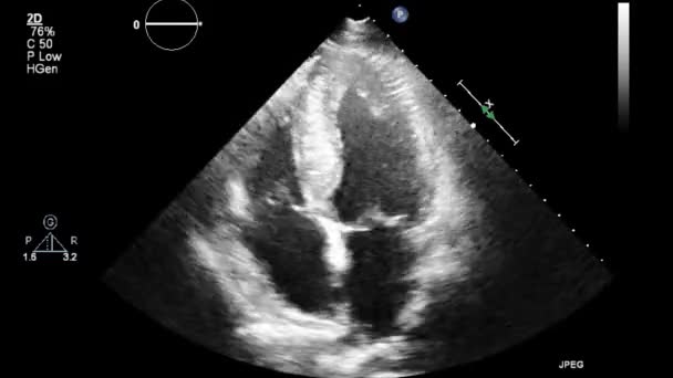 Ecografia Transesofagea Esame Del Cuore — Video Stock