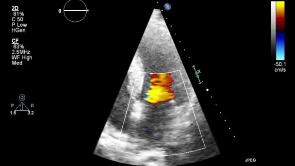 Transesofageale Echografie Onderzoek Van Het Hart — Stockvideo