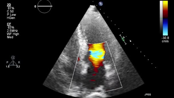 Transesofageální Ultrazvukové Vyšetření Srdce — Stock video