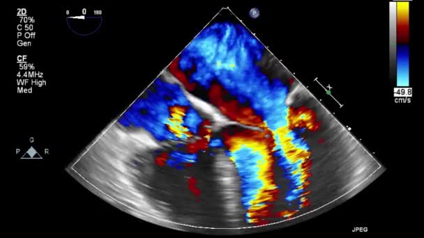 Ecografia Transesofagea Esame Del Cuore — Video Stock