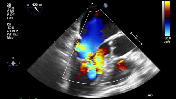 Transesofageální Ultrazvukové Vyšetření Srdce — Stock video