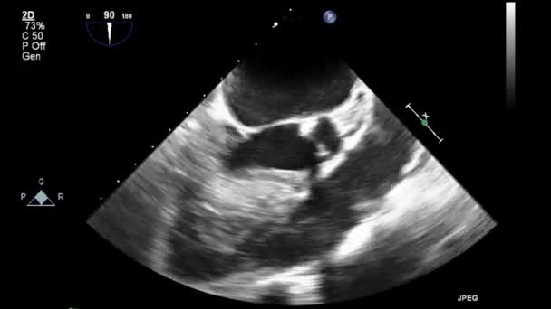 Transesofageale Echografie Onderzoek Van Het Hart — Stockvideo