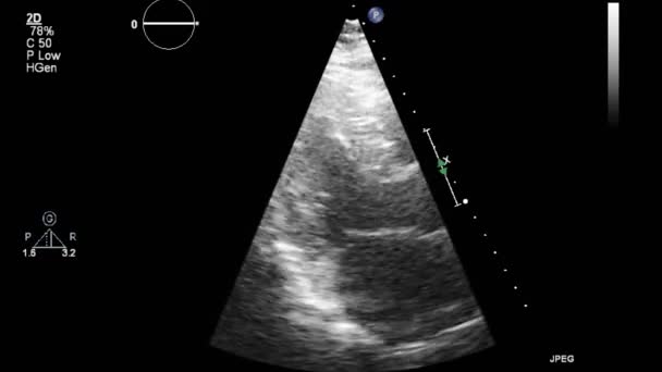 Transesofageální Ultrazvukové Vyšetření Srdce — Stock video