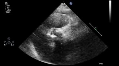 Kalbin yüksek kaliteli ultrason transsofageal muayenesi..