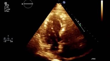Kalbin yüksek kaliteli ultrason transsofageal muayenesi..