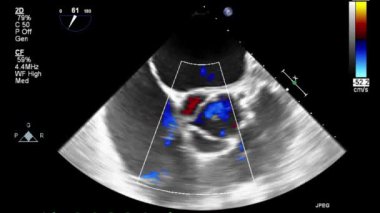 Kalbin yüksek kaliteli ultrason transsofageal muayenesi..