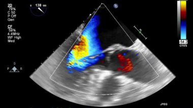 Kalbin yüksek kaliteli ultrason transsofageal muayenesi..