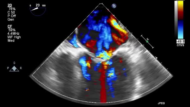 Hochwertige Video Ultraschall Transesophagealuntersuchung Des Herzens — Stockvideo