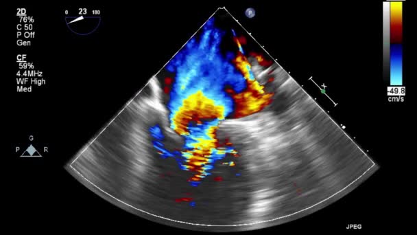 Examen Transesofágico Por Ultrasonido Video Alta Calidad Del Corazón — Vídeos de Stock