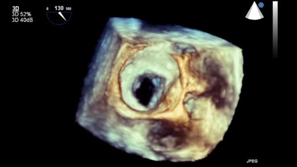 Hoge Kwaliteit Video Echografie Transslokdarmonderzoek Van Het Hart — Stockvideo