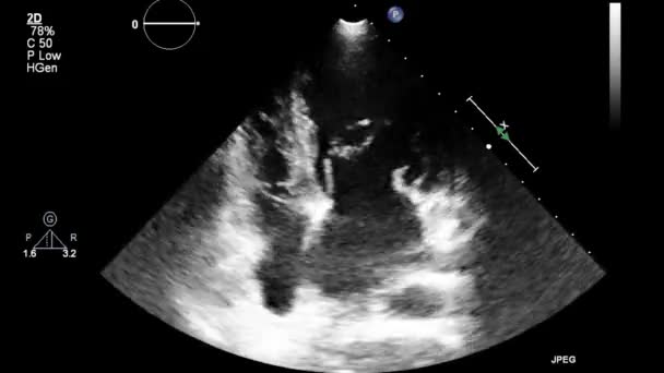 Examen Transesofágico Por Ultrasonido Video Alta Calidad Del Corazón — Vídeo de stock