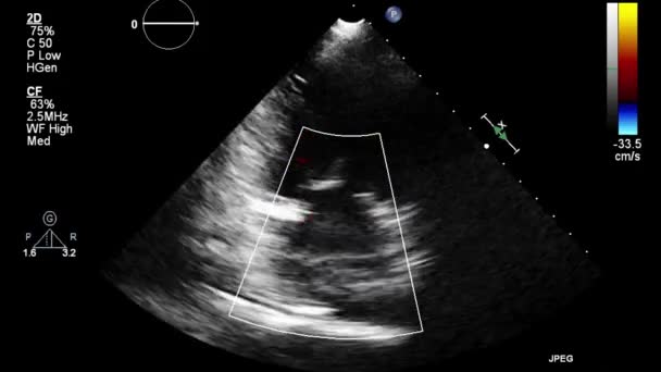 Hoge Kwaliteit Video Echografie Transslokdarmonderzoek Van Het Hart — Stockvideo