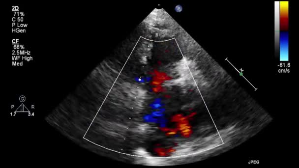 Hoge Kwaliteit Video Echografie Transslokdarmonderzoek Van Het Hart — Stockvideo