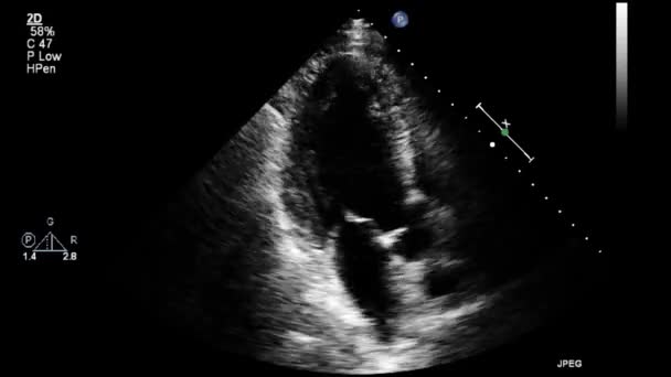 High Quality Video Ultrasound Transesophageal Examination Heart — Stock Video