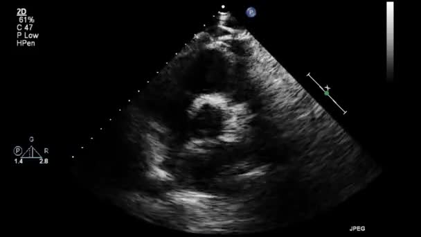 고품질 비디오 초음파 식도를 심장의 — 비디오