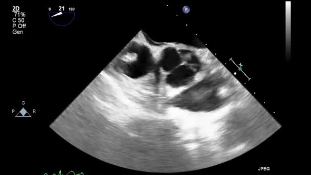 Examen Transesofágico Por Ultrasonido Video Alta Calidad Del Corazón — Vídeos de Stock