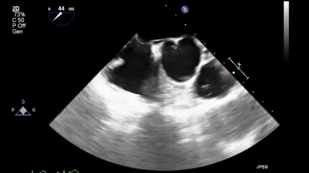 Échographie Vidéo Haute Qualité Examen Transœsophagien Cœur — Video