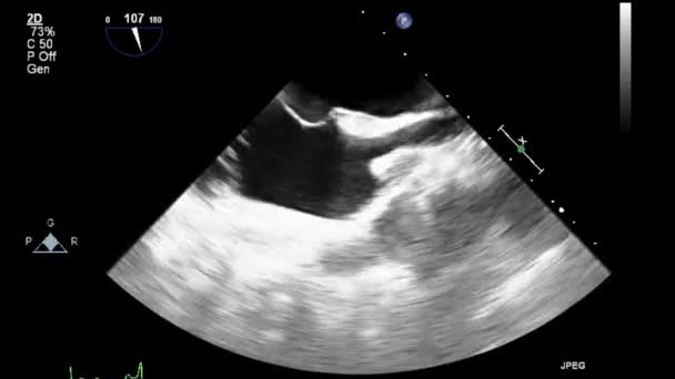 Ecografia Video Alta Qualità Esame Transesofageo Del Cuore — Video Stock