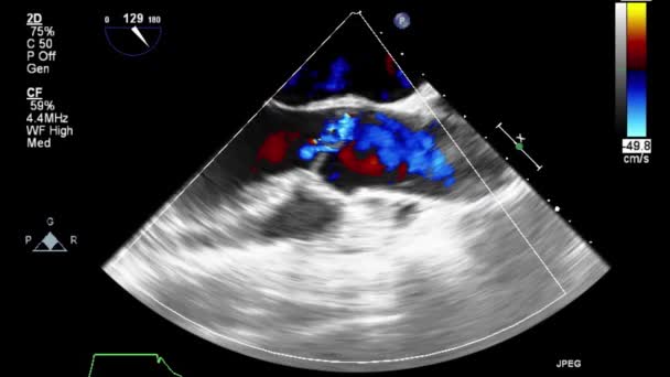 Hochwertige Video Ultraschall Transesophagealuntersuchung Des Herzens — Stockvideo