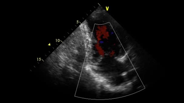 Examen Transesofágico Por Ultrasonido Video Alta Calidad Del Corazón — Vídeos de Stock